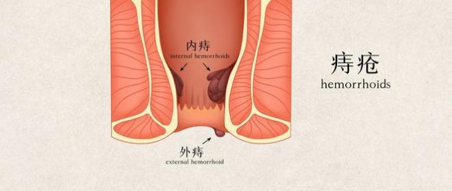 痔瘡凝膠廠家 痔瘡凝膠廠家