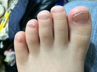 灰指甲藥膏廠家 灰指甲藥膏廠家
